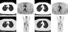 肺部结节可能导致肺癌