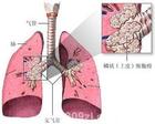 引起肺癌的因素有的是可以避免的