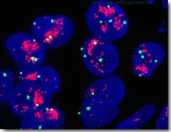 胰腺癌的基因检测