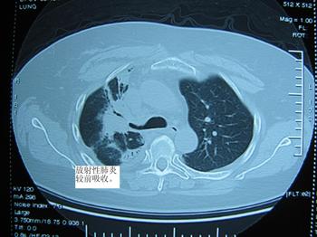 放疗病人要提防放射性肺炎