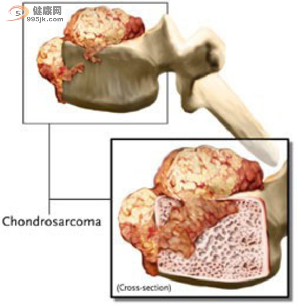 脊柱肿瘤的生长与包囊形成