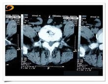 脊柱肿瘤平片基本征象分析