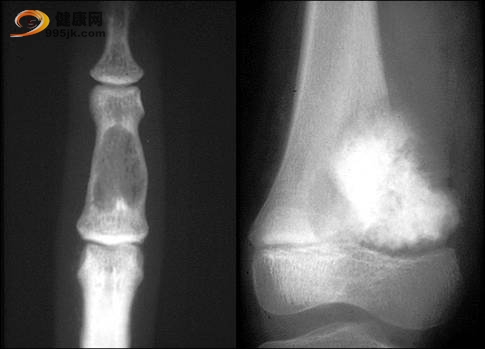 脊柱（骨）肿瘤CT检查方法