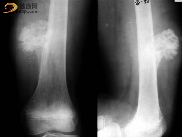 骨软骨瘤的影像学诊断