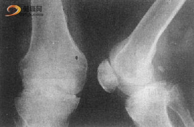 脊柱转移瘤的影像学诊断
