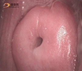 子宫癌治疗