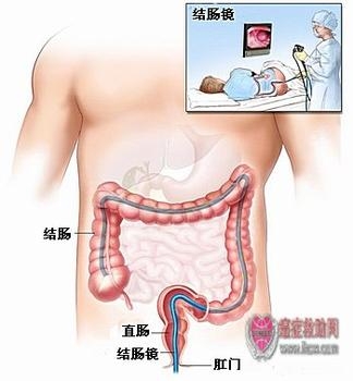 大肠癌的普通诊断方法