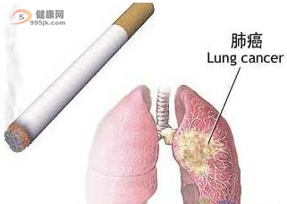 肺癌的最佳疗法