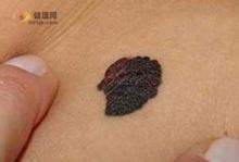 如何提高黑色素瘤的生存率