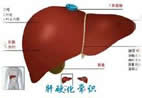 肝硬化常识