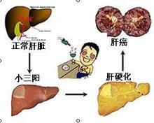 肝硬化症状