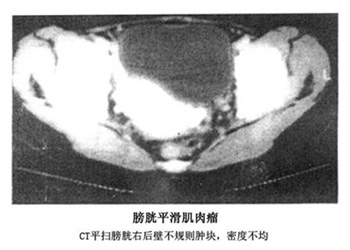膀胱癌症状