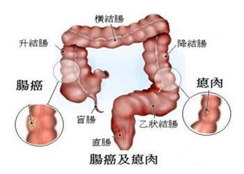 结肠癌有哪些临床表现