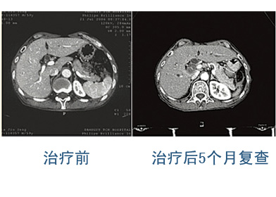 中医治疗胰腺癌的优势