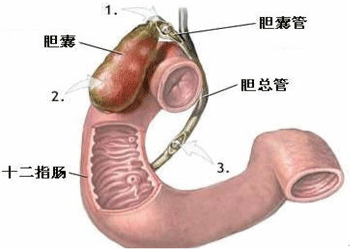 诱发胆囊癌的八大危险因素