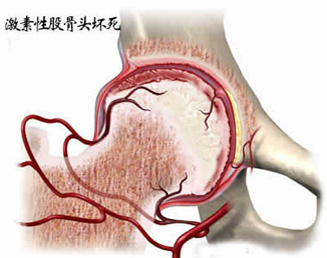 股骨头坏死的症状