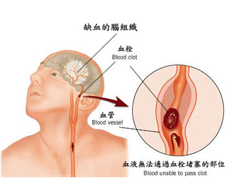 导致偏瘫的原因都有哪些？