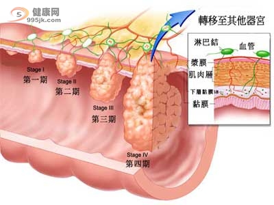 大肠癌的治疗方法 大肠癌的分期