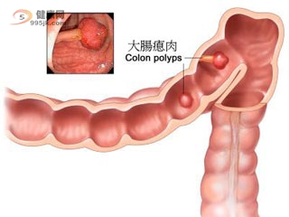 常见的大肠癌诊断方法