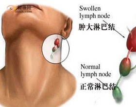 淋巴癌早期症状的表现有哪些