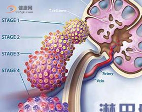 患淋巴癌的原因是什么