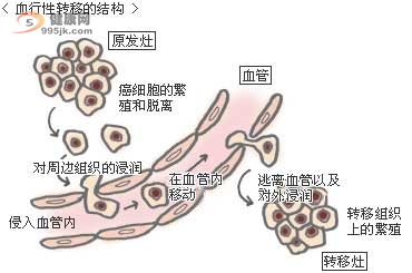 直肠癌转移方式和治疗方法