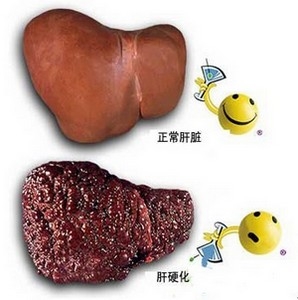 早期肝硬化症状表现
