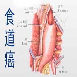 食道癌中医治疗