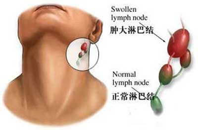 医生说的淋巴瘤是淋巴癌吗？