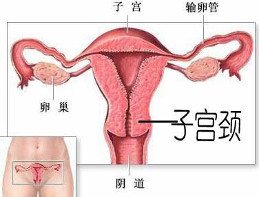 宫颈癌护理要点