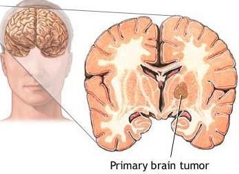 脑瘤有什么明显的症状表现