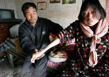 直肠癌患者的晚期症状表现