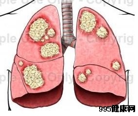肺癌常识