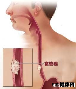 食道癌早期症状