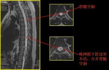 健康咨询脊髓空洞症的病因有那些症状表现