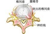 脊髓空洞症也会引起肌肉萎缩吗？