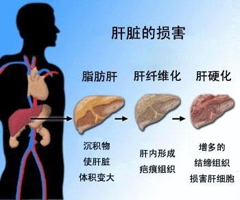 轻度肝硬化