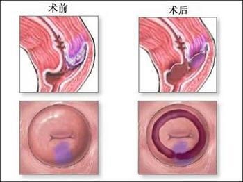 膀胱癌的手术治疗常用方法