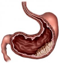 胃癌能活多久 胃癌的治疗方法有哪些 中医治疗胃癌