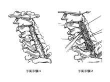 得了脊髓肿瘤该如何治疗效果好