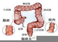得了直肠癌怎么办