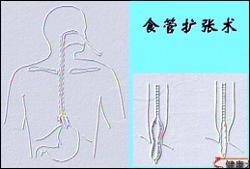 食管贲门失弛缓症