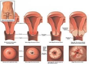 宫颈癌可能会是因为雌激素诱发的