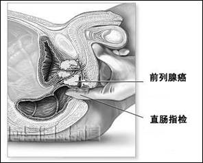 前列腺癌症状治愈率