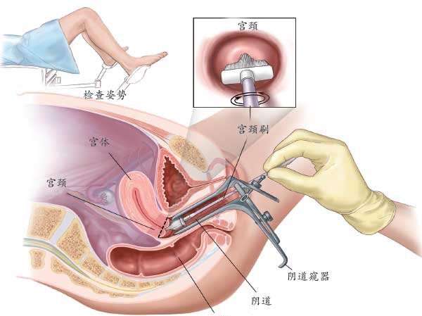 得了宫颈癌能活多久?