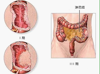 直肠癌的发病人群