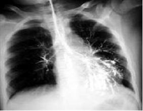 肺部感染怎么治疗