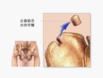 慢粒白血病骨髓移植效果好吗