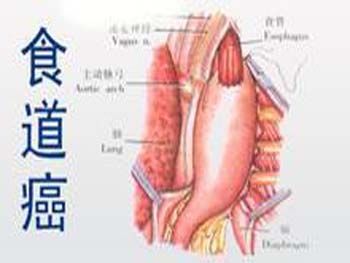 持续吞咽困难就一定是食管癌吗