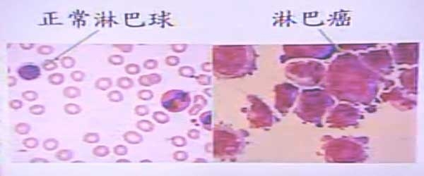 淋巴癌最新治疗方法